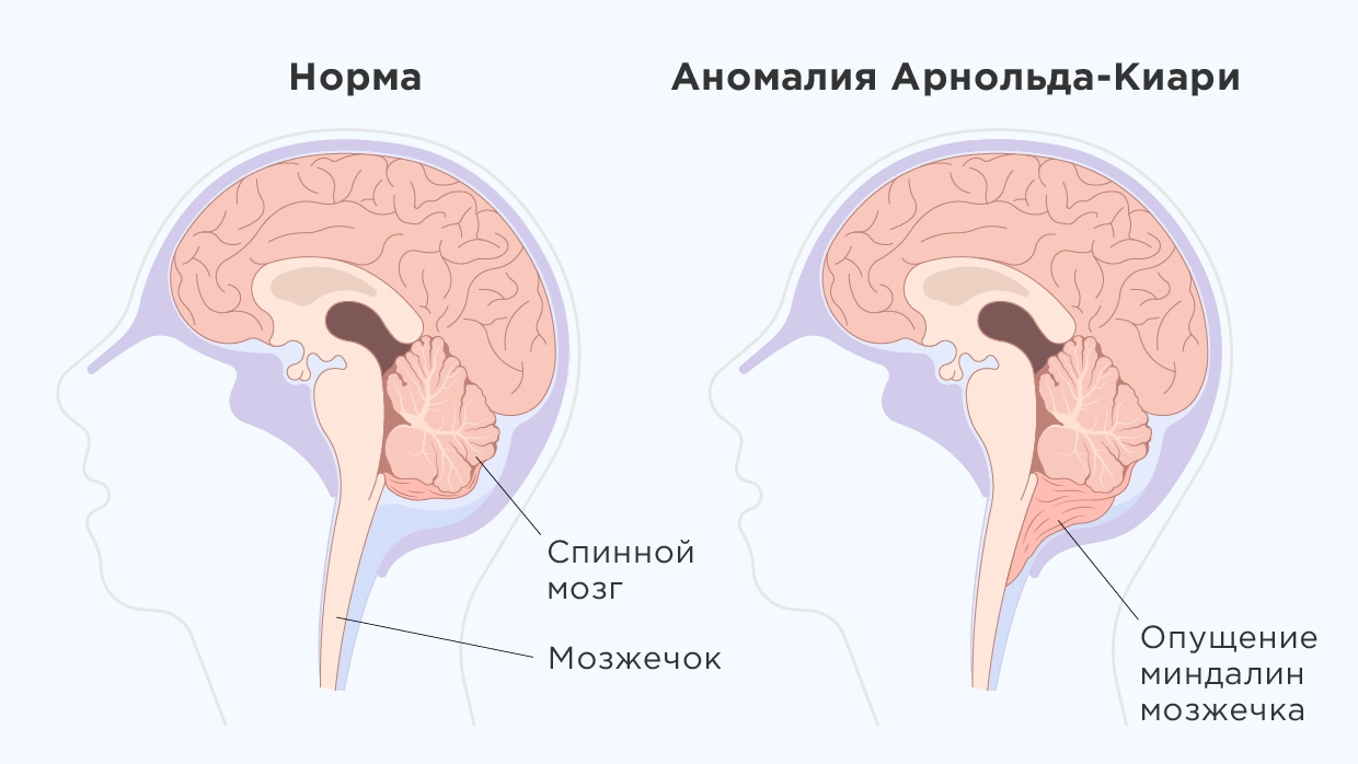 Аномалия Арнольда-Киари - причины, симптомы, диагностика и лечение